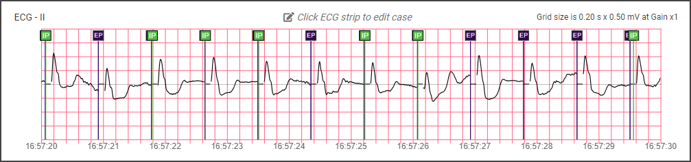 External pacing event indicators above each complex where pacing was delivered.